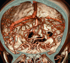 The Mind Project's Virtual Stroke Lab EMR Entry - What is 3D CT ...